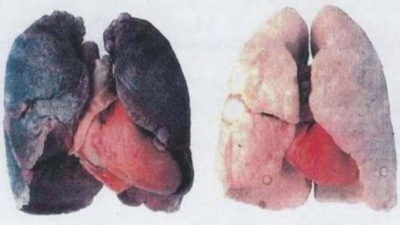 Many chronic drinkers die from lung damage (left)