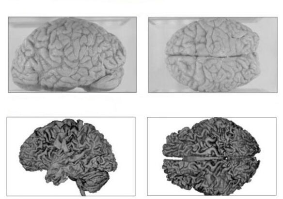 The brain of a healthy person (top) and the brain of an alcoholic with irreversible consequences (below)