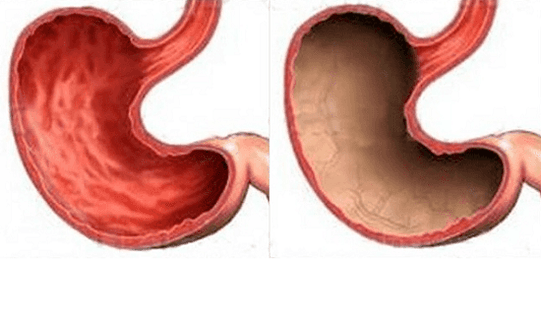 Ulcers, gastritis, cancer and other pathologies of the stomach (right side), manifested by alcohol